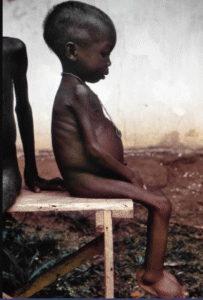 a biafran child suffering kwashiokor